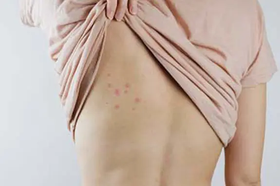 A man pulling up shirt to reveal bed bug bites on back - commercial bed bug control in Indiana, Illinois and Kentucky