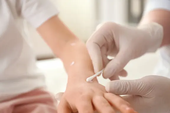 Adult applying medicine to child's bed bug bites - keep your family safe from bed bugs with Action Pest in Indiana, Illinois and Kentucky