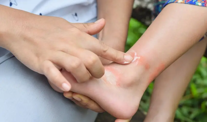 Rubbing cream on a mosquito bite. Many over-the-counter products that treat mosquito bites help with swelling, itching, and soreness.